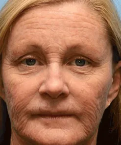 Rekulo™ Botox Bee Venom Wrinkle Removal Cream