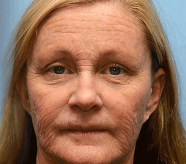 Rekulo™ Botox Bee Venom Wrinkle Removal Cream